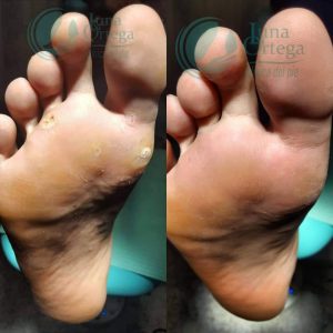 Lee más sobre el artículo Papilomas (Verrugas Plantares)