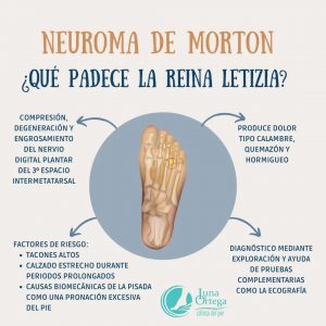 Lee más sobre el artículo Neuroma de Morton