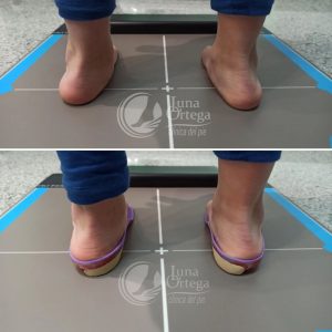 Lee más sobre el artículo Tratamiento Ortopodológico pie plano valgo