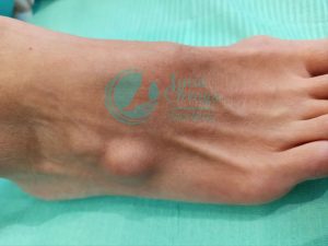 Lee más sobre el artículo Ganglión Dorsal