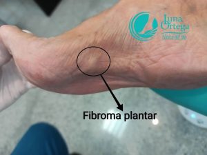 Lee más sobre el artículo Fibromatosis Plantar