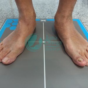 Lee más sobre el artículo ¿Qué es el pie plano valgo?