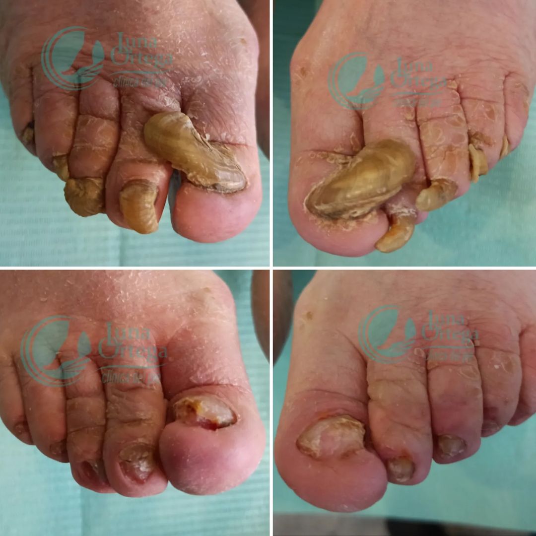 Lee más sobre el artículo Onicogrifosis severa