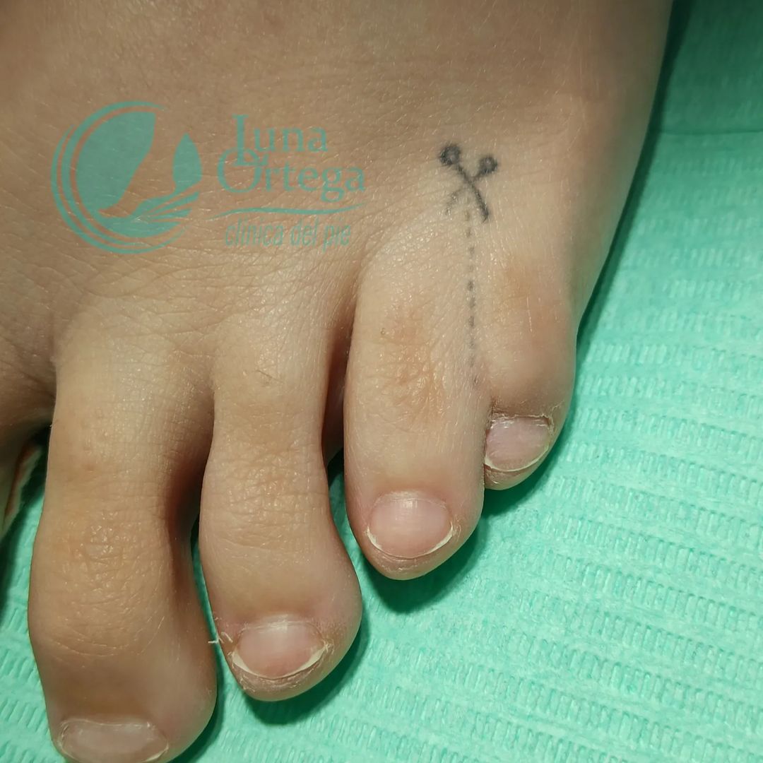 Lee más sobre el artículo ¿Qué es la sindactilia?