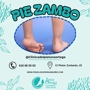 Lee más sobre el artículo El pie ZAMBO