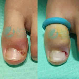 Lee más sobre el artículo La onicocriptosis o uña encarnada