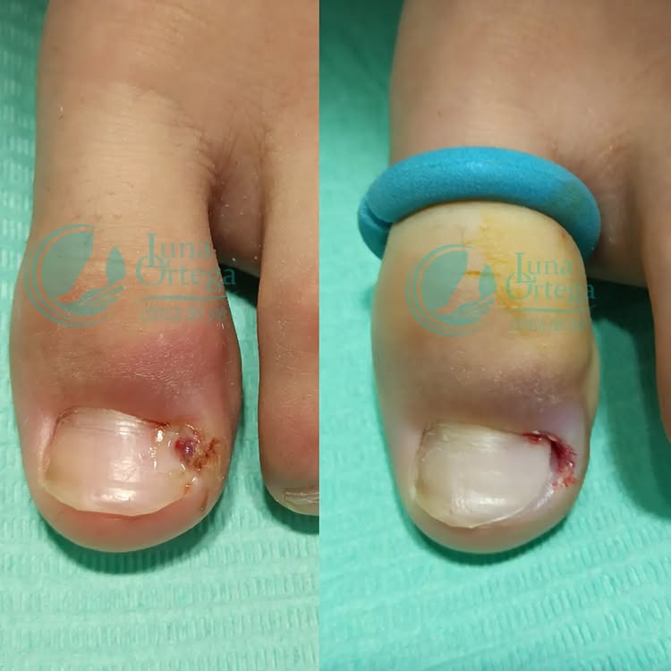 Lee más sobre el artículo La onicocriptosis o uña encarnada