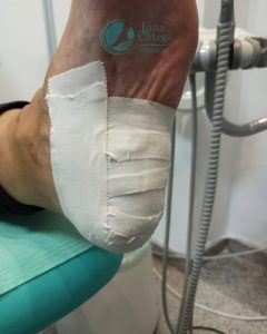 Lee más sobre el artículo ¿Qué es un Low-dye taping? ¿Padeces de FASCITIS PLANTAR?