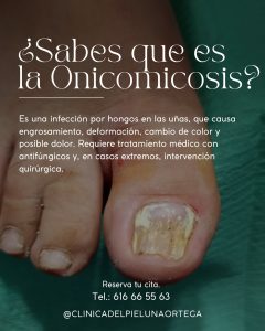 Lee más sobre el artículo ¿Sabes qué es la Onicomicosis?