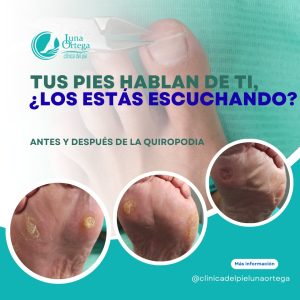 Lee más sobre el artículo Después del verano, tus pies también merecen una revisión