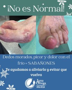 Lee más sobre el artículo ¿Dedos rojos o morados con el frío?Puede que no sea “piel sensible»