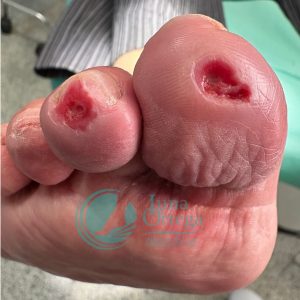 Lee más sobre el artículo Úlcera en el pie diabético