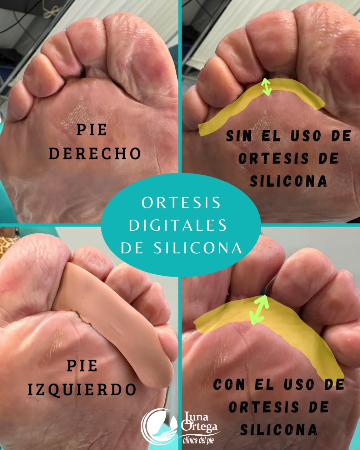 Lee más sobre el artículo Ortesis digitales de silicona