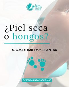 Lee más sobre el artículo DERMATOMICOSIS EN LOS PIES: cuando los hongos avanzan, la piel avisa
