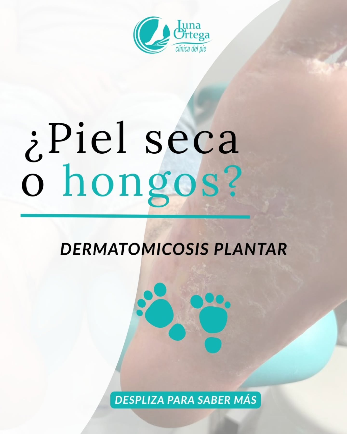 Lee más sobre el artículo DERMATOMICOSIS EN LOS PIES: cuando los hongos avanzan, la piel avisa