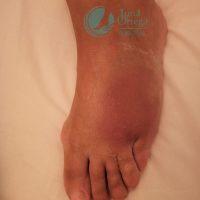 torcedura de tobillo