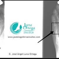 torcedura de tobillo2
