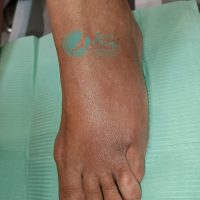 torcedura de tobillo3