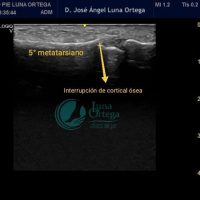 torcedura de tobillo4